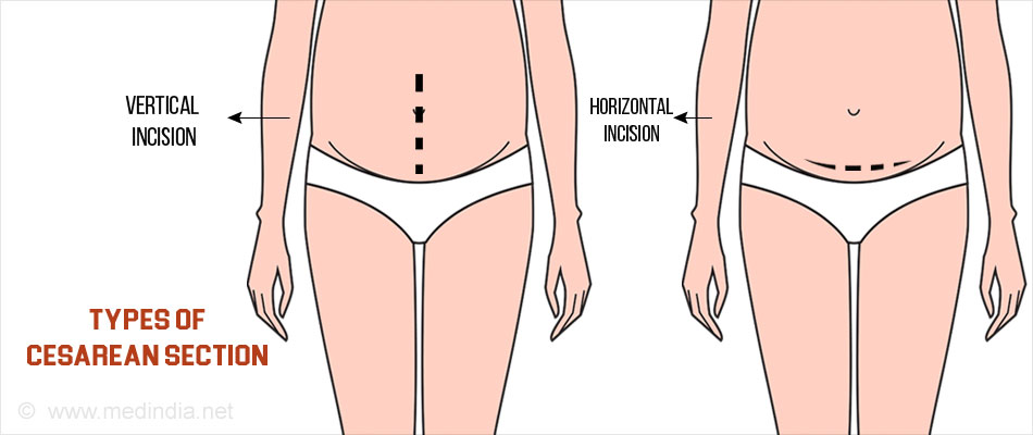 Planned Cesarean Section – Things Parenting - 950x400 - jpeg C Section Technique